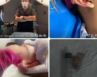 Casi pierde la oreja por un piercing  y el servicio de ORL del Hospital Universitario de Maracaibo se la salvó