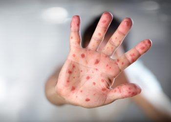 Cinco países europeos registran ocho casos de viruela del mono